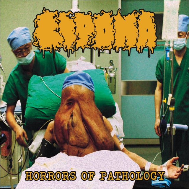 lipoma-horrors-of-pathology